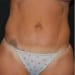 Tummy Tuck 8 After Patient