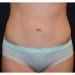 Tummy Tuck 9 After Patient