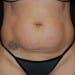 Tummy Tuck 8 Before Patient