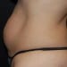 Tummy Tuck 8 Before - 2 Patient