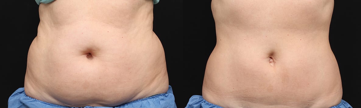 CoolSculpting® vs. Liposuction vs. Tummy Tuck: Recovery Time