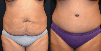 Tummy Tuck Recovery Tips for Healing as Quickly as Possible
