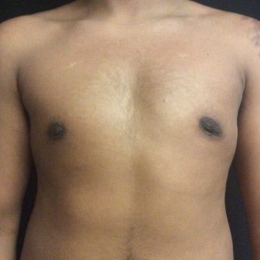 Liposuction Before and After Photo Gallery, San Diego, CA