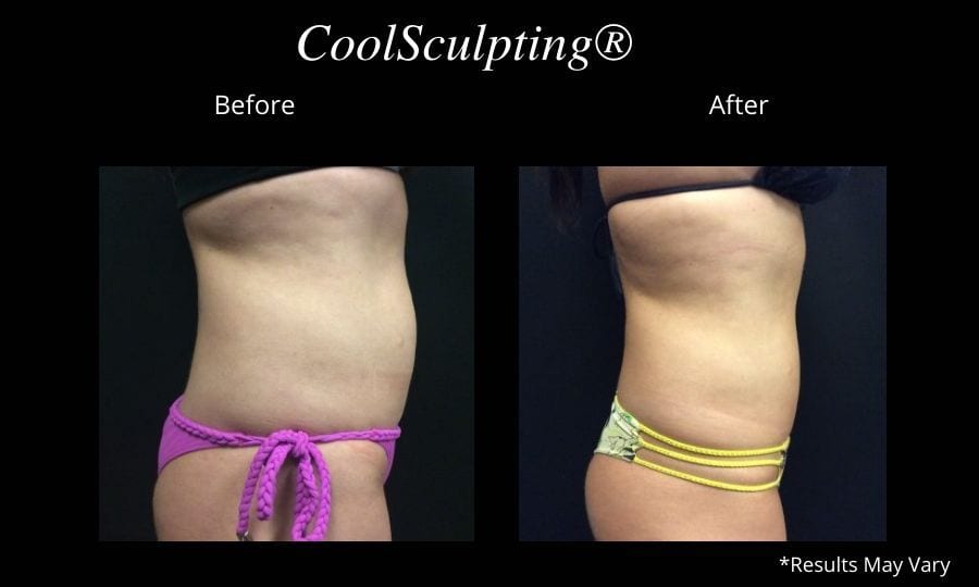 Liposuction Vs. CoolSculpting®: Which Is Best for Me?